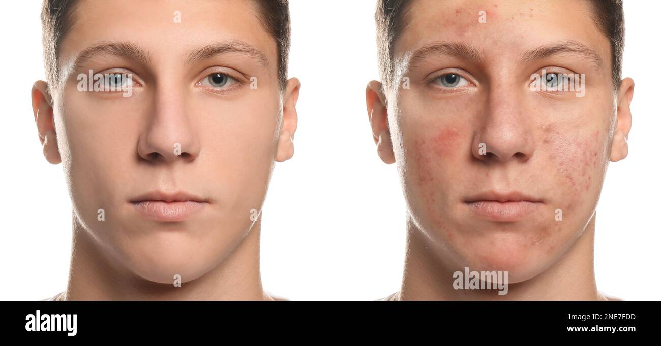 Collage avec des photos de l'adolescent type avec problème d'acné avant et après le traitement sur fond blanc. Bannière Banque D'Images