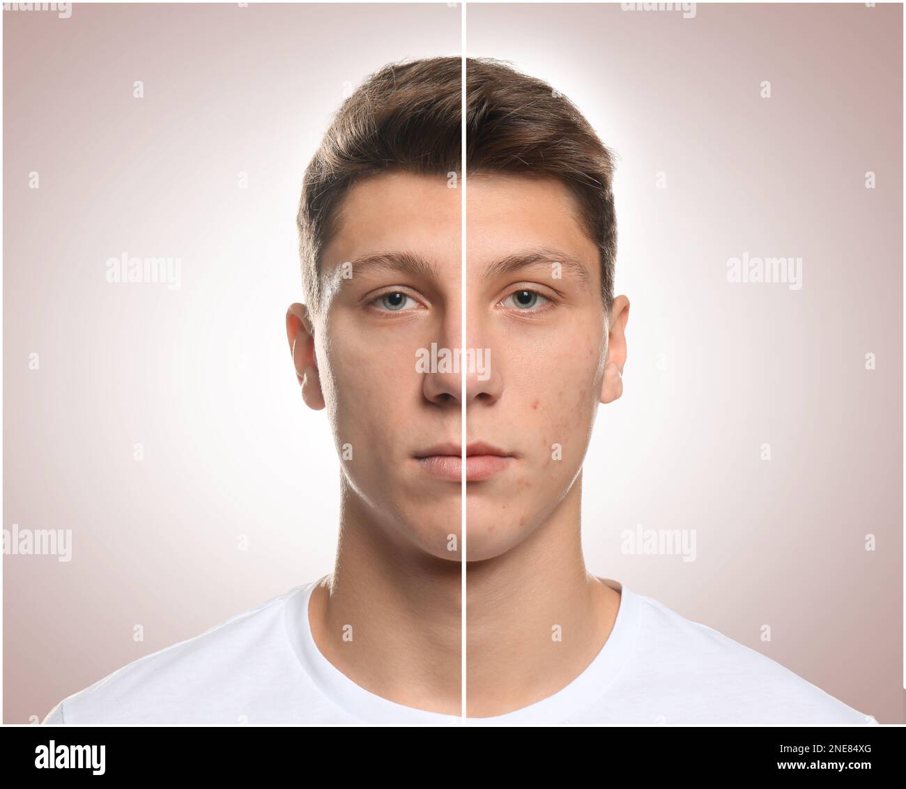 Adolescent type avec problème d'acné avant et après le traitement sur fond clair, collage Banque D'Images