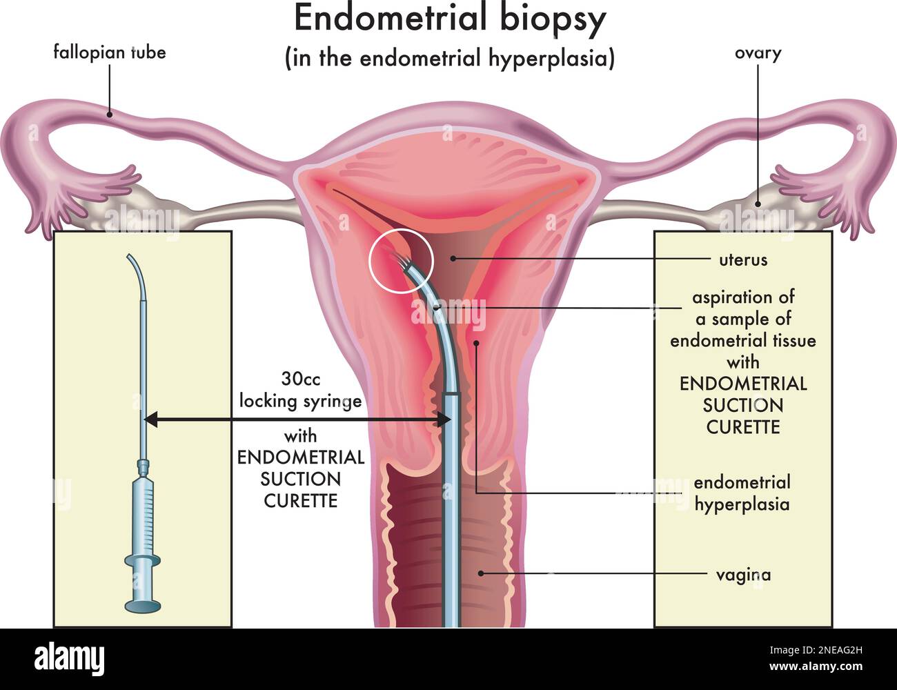 Illustration médicale de la procédure de biopsie de l'endomètre dans l'hyperplasie de l'endomètre avec annotations. Illustration de Vecteur