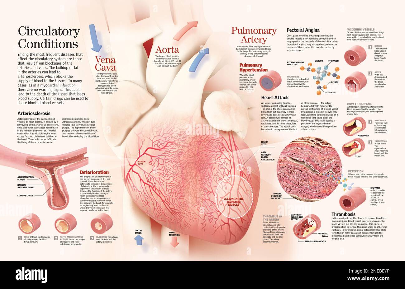 Infographie de certaines maladies de l'appareil circulatoire comme la crise cardiaque et l'angine de poitrine. [QuarkXPress (.qxp); 6259x4015]. Banque D'Images