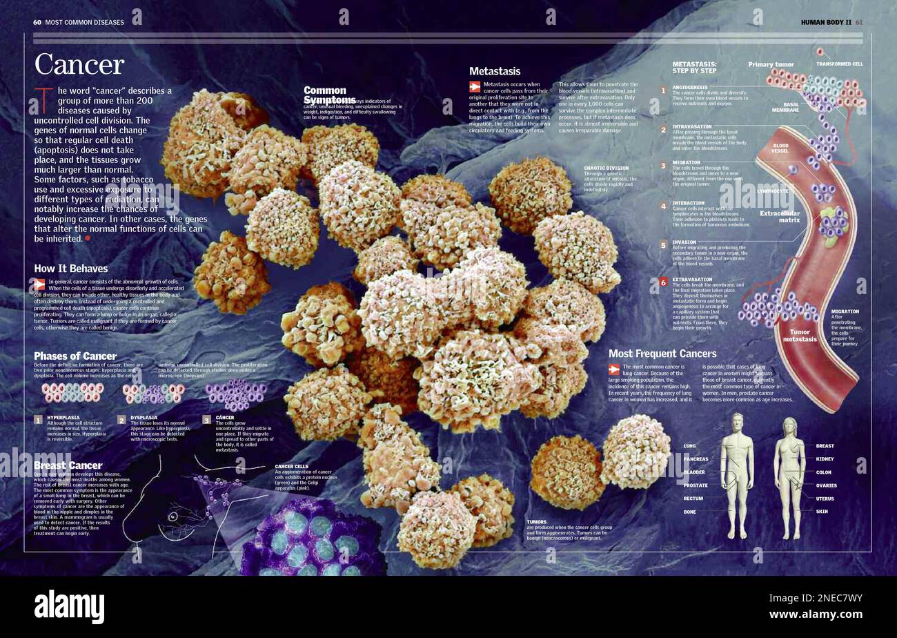 Il comprend des illustrations du tissu cancéreux, des stades du cancer