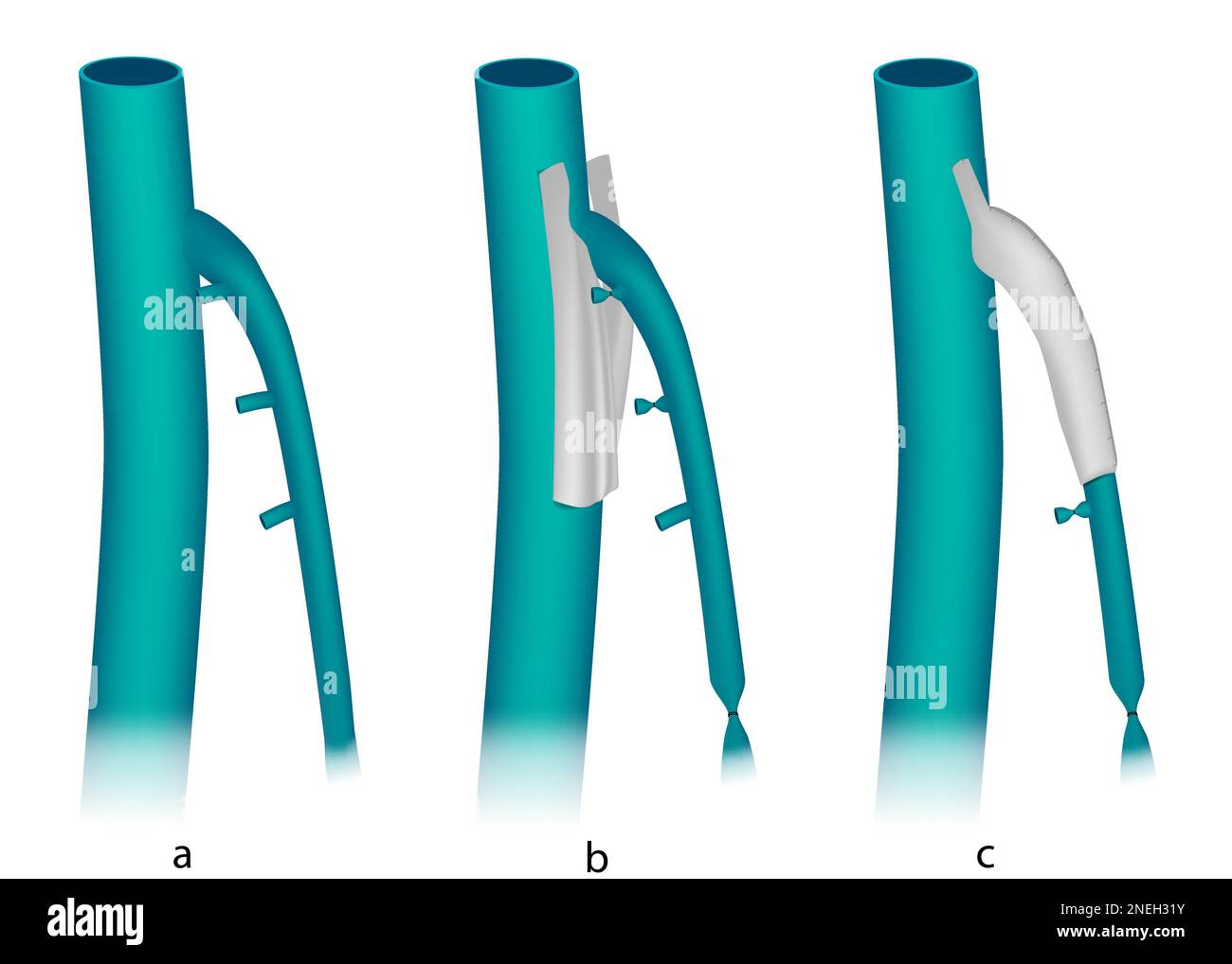 Bandes externes de valvuloplastie de la jonction saphéno-fémorale dans les veines saphènes importantes insuffisantes. Traitement d'insuffisance veineuse Venoablation. Illustration de Vecteur