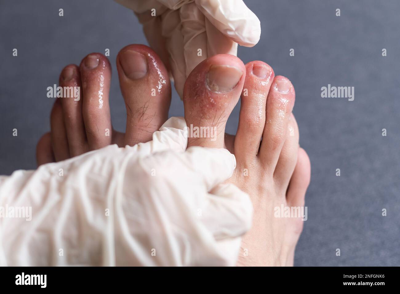 Orteils Covid. Symptômes du coronavirus - gonflement et décoloration,  couleur violacée, douleur et peau rugueuse Photo Stock - Alamy