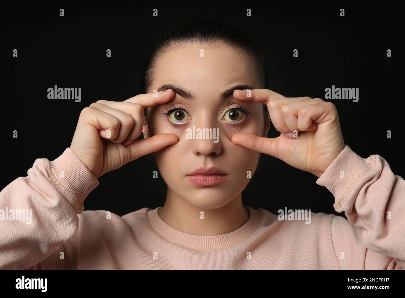 Femme vérifiant son état de santé sur fond noir. Yeux jaunes comme symptôme de problèmes avec le foie Banque D'Images