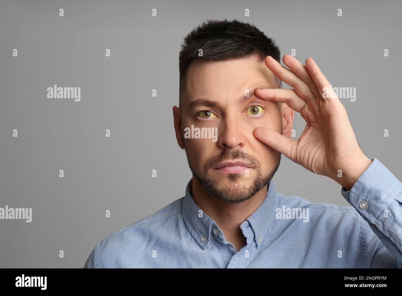 Homme vérifiant son état de santé sur fond gris, espace pour le texte. Yeux jaunes comme symptôme de problèmes avec le foie Banque D'Images