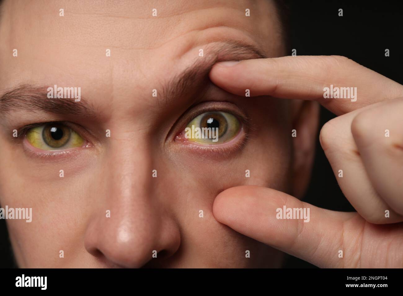 Homme vérifiant son état de santé sur fond noir, gros plan. Yeux jaunes comme symptôme de problèmes avec le foie Banque D'Images