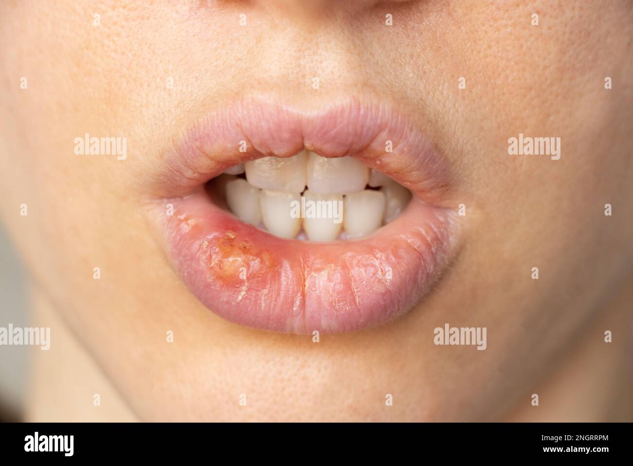 Maladie des lèvres Banque de photographies et d'images à haute résolution -  Alamy