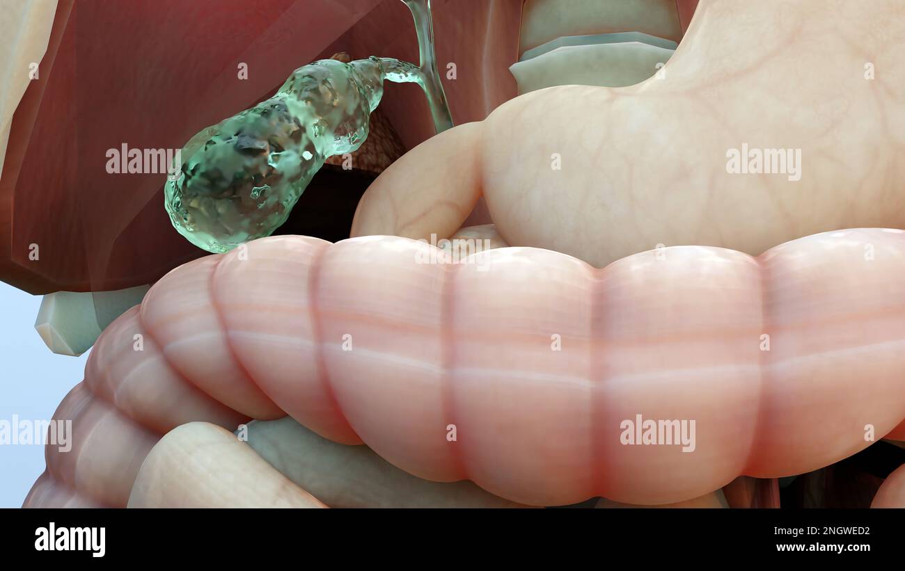 Calculs biliaires dans le canal biliaire, silhouette humaine et anatomie des organes environnants, foie et vésicule biliaire avec calculs, rendu réaliste 3D Banque D'Images