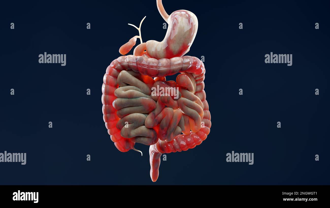 Homme souffrant de la maladie de crohns, anatomie masculine, inflammation gros intestin, Sigmoïd Colon, parties du système digestif humain, rendu 3D Banque D'Images