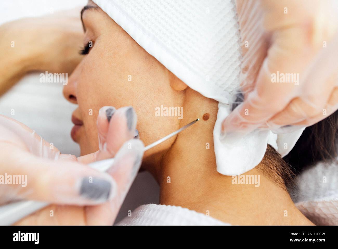 Une belle jeune femme caucasienne fait une procédure d'enlèvement de mole sur son cou dans une clinique dermatologique cosmétique de beauté moderne. Traite les grains de beauté de la peau Banque D'Images
