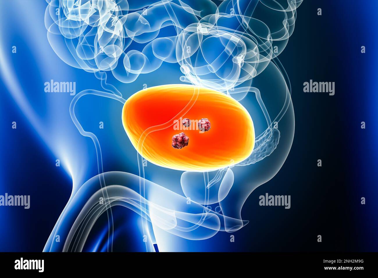 Cancer de la vessie urinaire avec des organes et des tumeurs ou des cellules cancéreuses 3D rendant illustration avec le corps masculin. Anatomie, oncologie, biomédical, maladie, médicament Banque D'Images