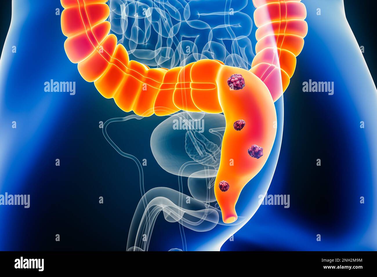 Rectum ou cancer colorectal avec des organes et des cellules cancéreuses 3D en montrant l'illustration avec le corps masculin. Anatomie, oncologie, maladies des intestins ou des entrailles, Banque D'Images