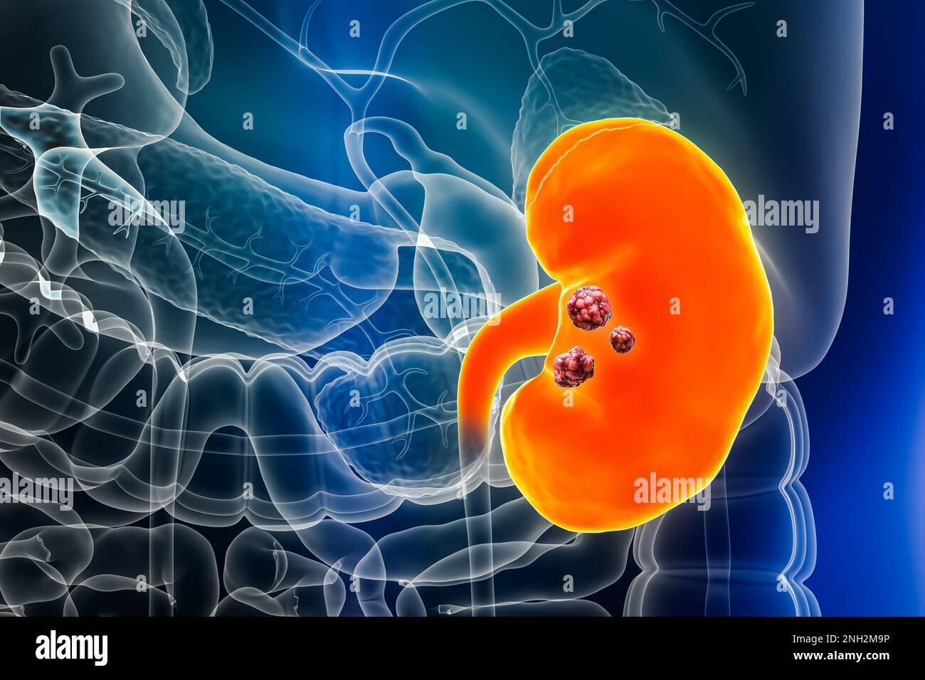 Cancer du rein ou du bassinet avec des organes et des tumeurs ou des cellules cancéreuses 3D illustration du résultat. Anatomie, oncologie, biomédical, néphrologie, maladie, Banque D'Images