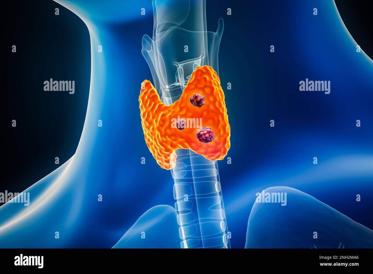 Cancer de la thyroïde avec des organes et des tumeurs ou des cellules cancéreuses 3D en donnant l'illustration avec les contours du corps masculin. Anatomie, oncologie, biomédical, médical, bi Banque D'Images
