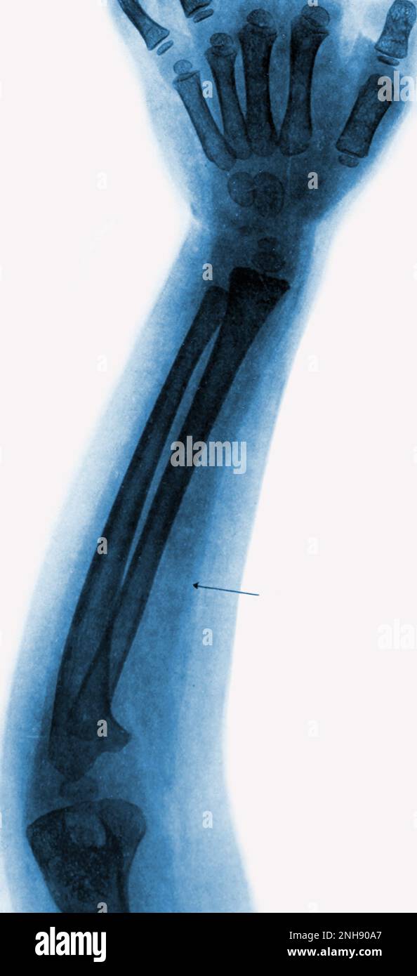 Radiographie du bras gauche d'un enfant de 4 ans atteint de polio, montrant un muscle atrophié (voir flèche). Colorisé. Banque D'Images