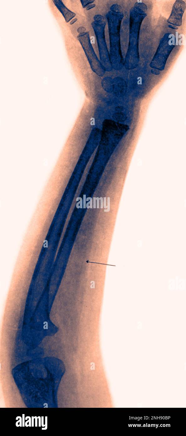 Radiographie du bras gauche d'un enfant de 4 ans atteint de polio, montrant un muscle atrophié (voir flèche). Colorisé. Banque D'Images
