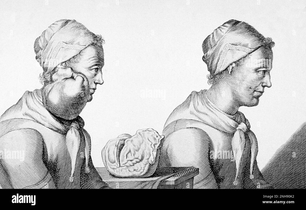 Deux vues, avant et après, de Clara Jacobi, une néerlandaise qui avait une tumeur enlevée de son cou en 1689. Banque D'Images