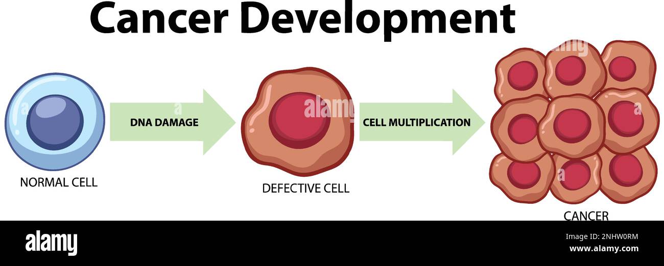 Illustration du développement des cellules tumorales et du cancer Illustration de Vecteur