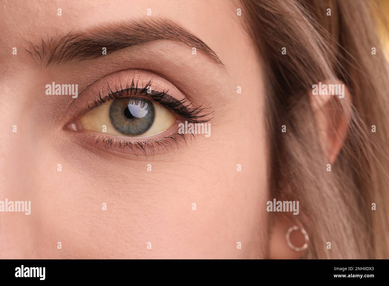 Femme aux yeux jaunes, gros plan. Symptômes des problèmes hépatiques Banque D'Images