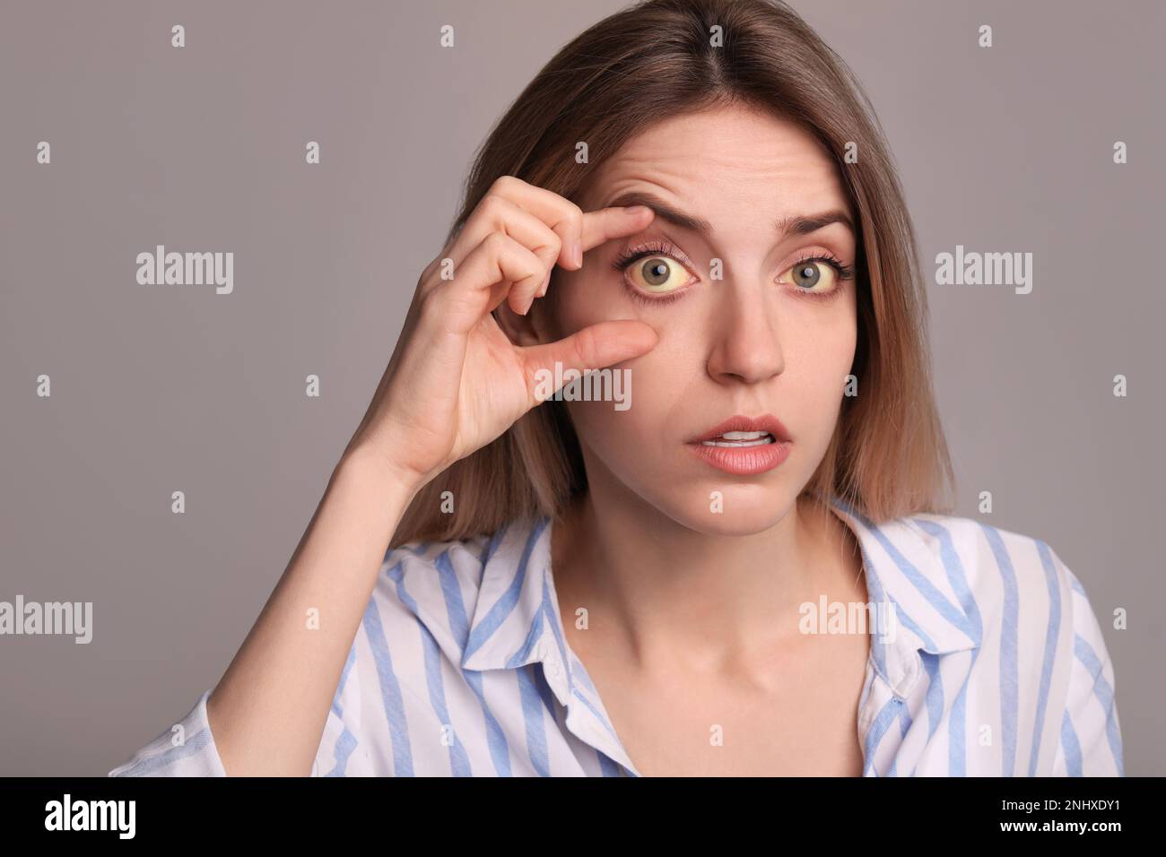 Femme vérifiant son état de santé sur fond gris. Yeux jaunes comme symptôme de problèmes avec le foie Banque D'Images