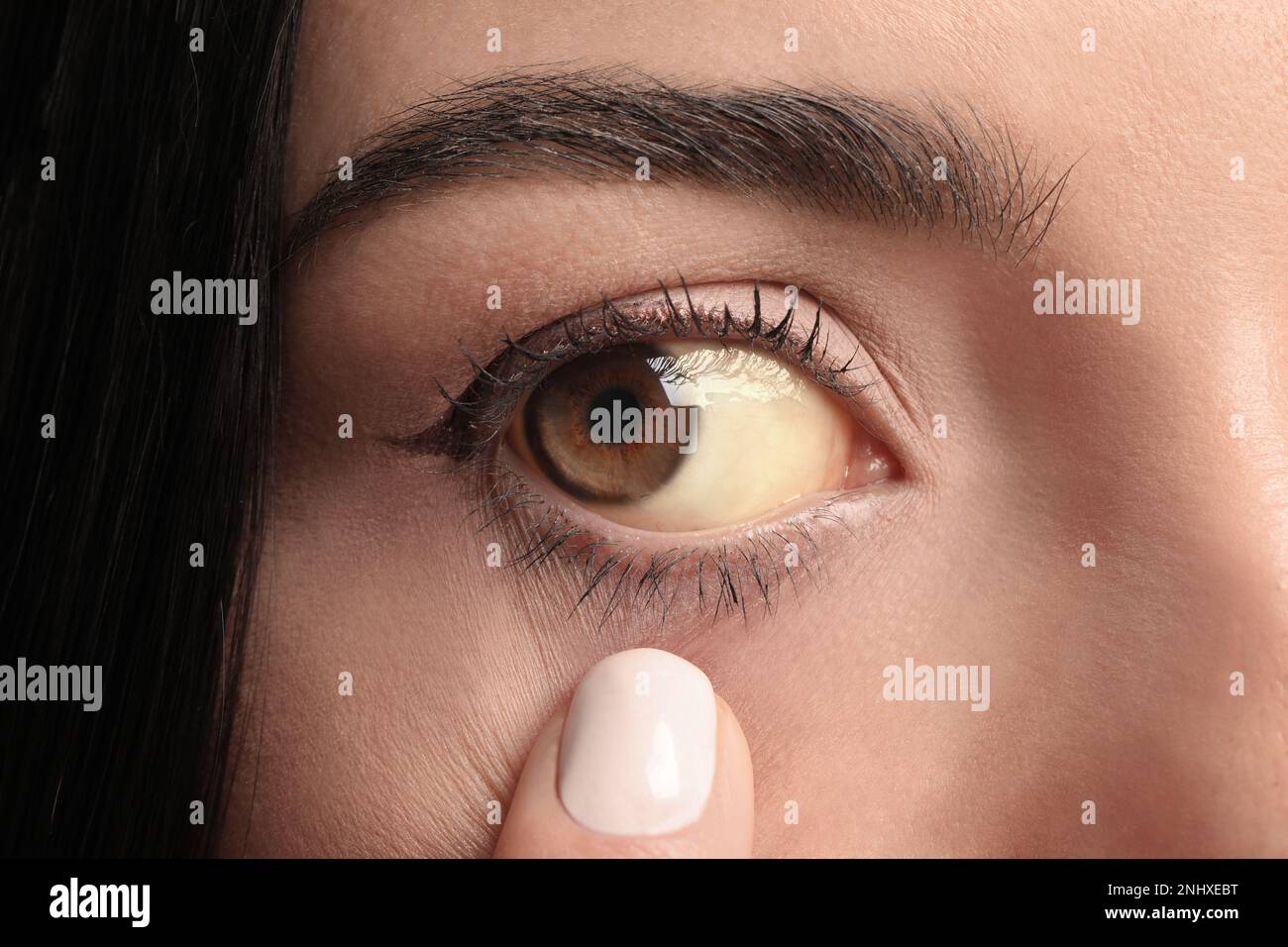 Femme vérifiant son état de santé, gros plan. Yeux jaunes comme symptôme de problèmes avec le foie Banque D'Images