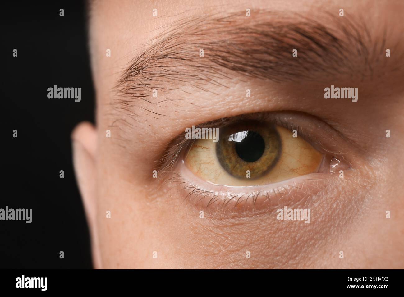 Homme avec des yeux jaunes sur fond noir, gros plan. Symptômes des problèmes hépatiques Banque D'Images