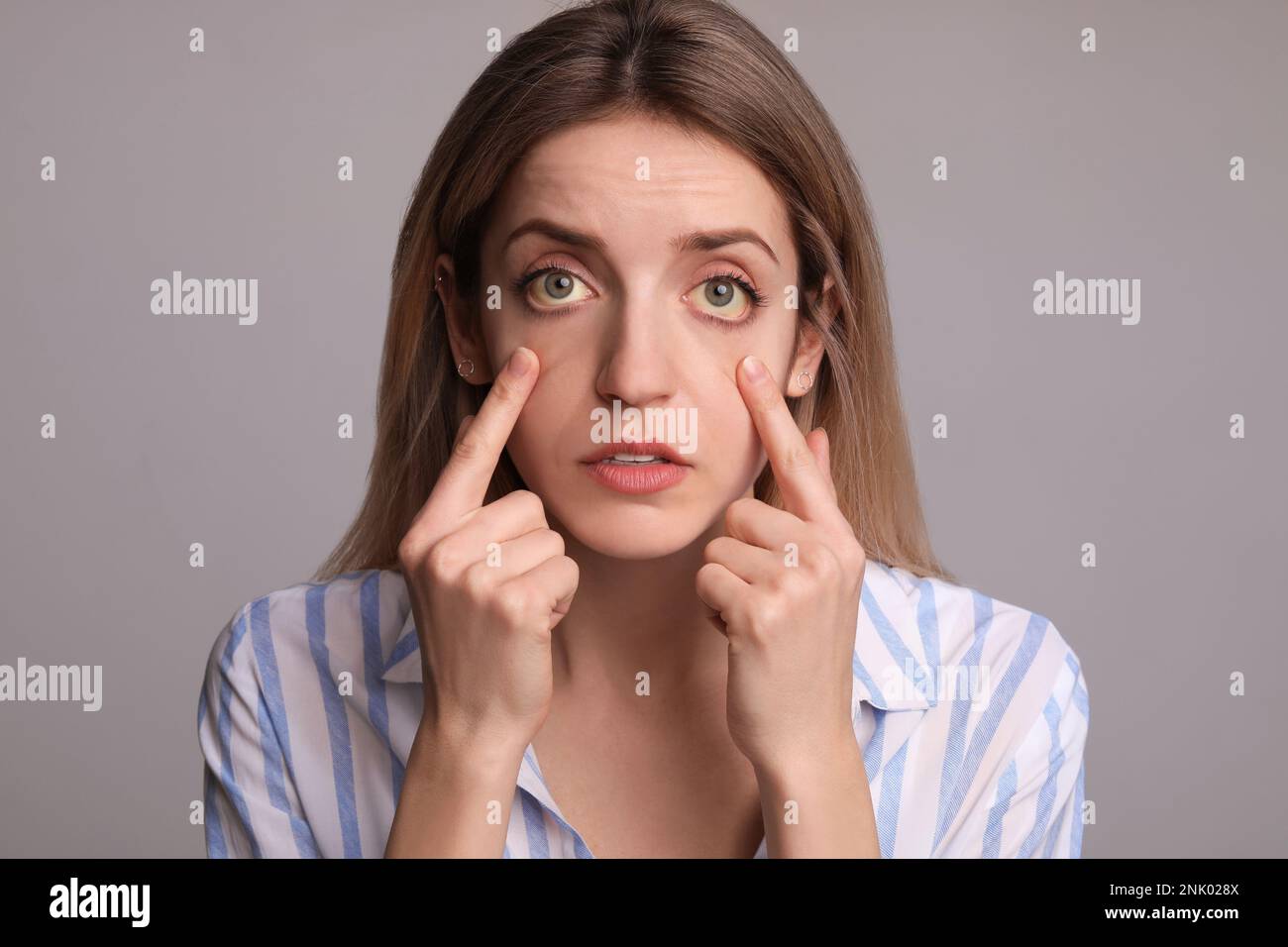 Femme vérifiant son état de santé sur fond gris. Yeux jaunes comme symptôme de problèmes avec le foie Banque D'Images