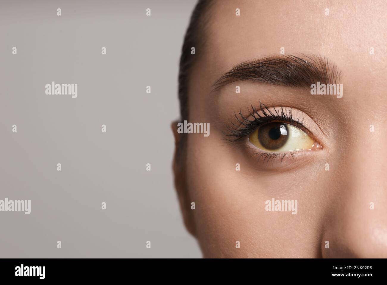 Femme avec des yeux jaunes sur fond gris, gros plan et espace pour le texte. Symptômes des problèmes hépatiques Banque D'Images