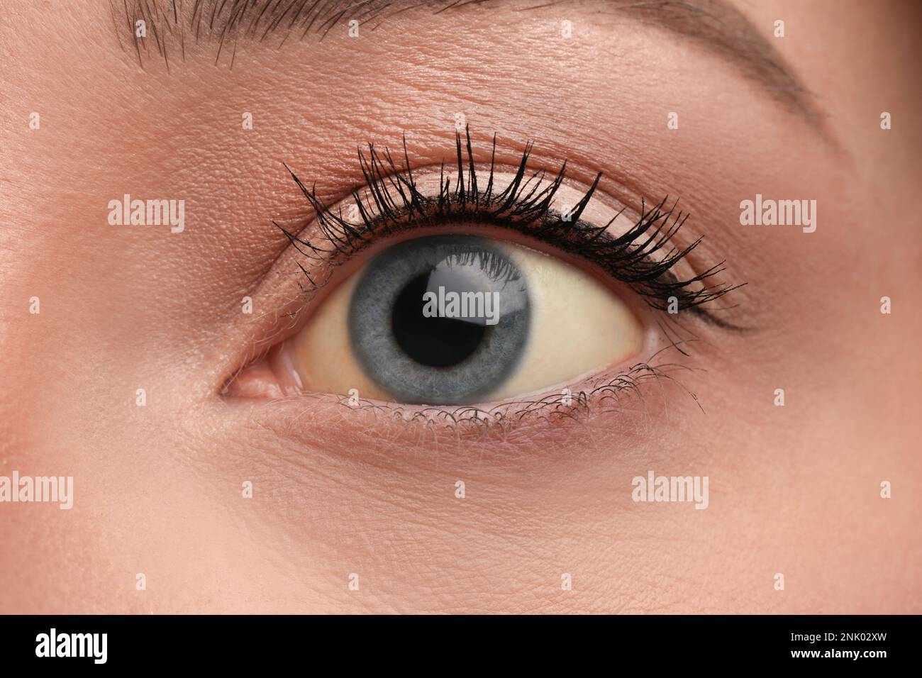 Femme avec les yeux jaunes comme arrière-plan, gros plan. Symptômes des problèmes hépatiques Banque D'Images