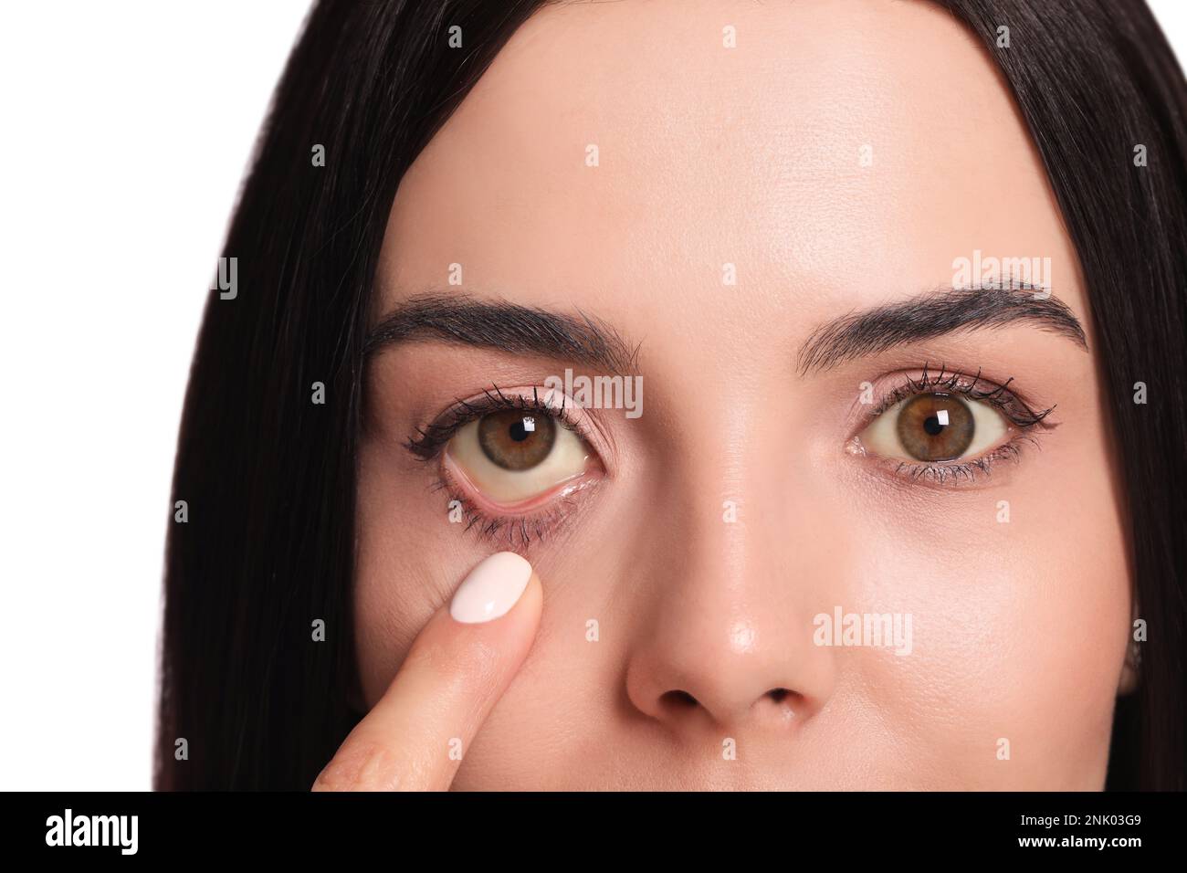 Femme vérifiant son état de santé sur fond blanc, gros plan. Yeux jaunes comme symptôme de problèmes avec le foie Banque D'Images