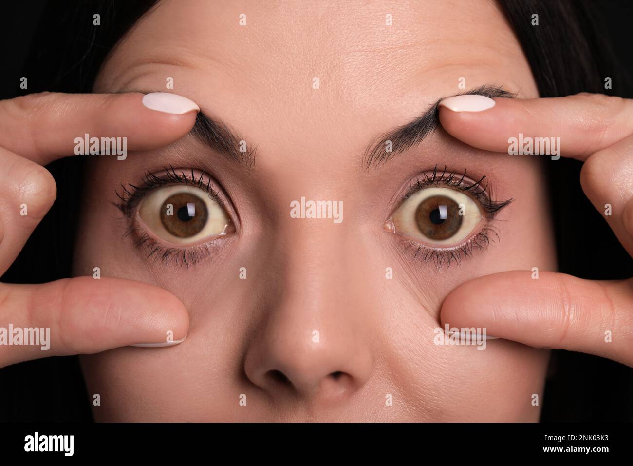 Femme vérifiant son état de santé, gros plan. Yeux jaunes comme symptôme de problèmes avec le foie Banque D'Images