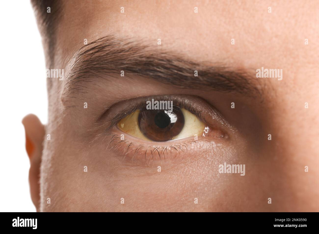 Homme avec des yeux jaunes sur fond blanc, gros plan. Symptômes des problèmes hépatiques Banque D'Images