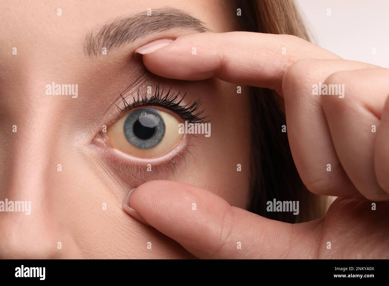 Femme aux yeux jaunes, gros plan. Symptômes des problèmes hépatiques Banque D'Images