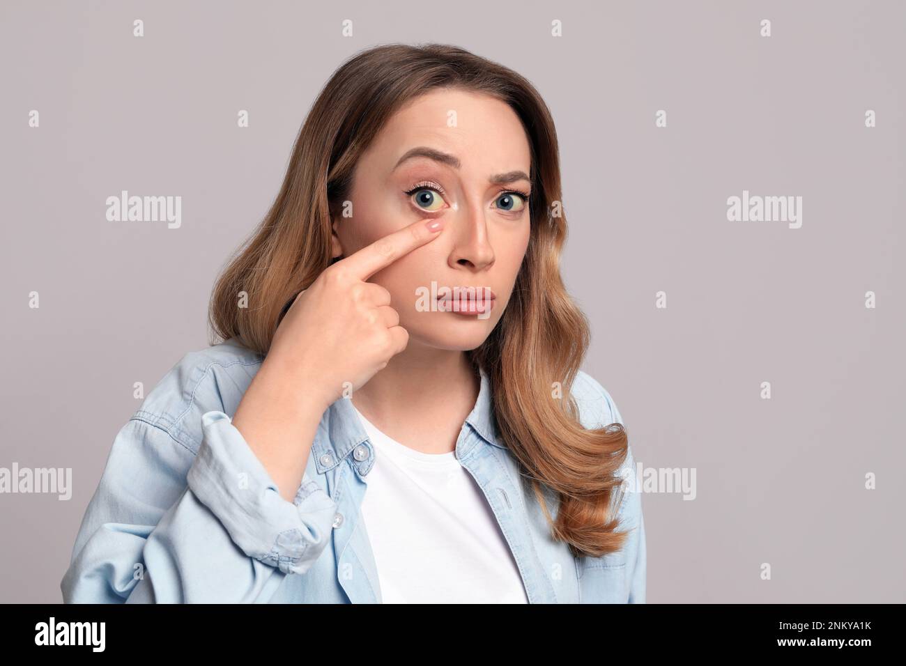 Femme avec des yeux jaunes sur fond gris. Symptômes des problèmes hépatiques Banque D'Images