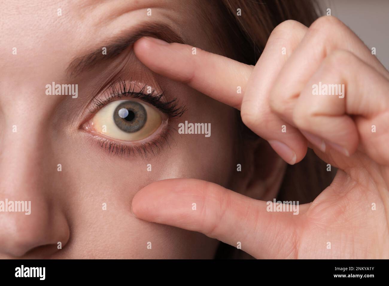 Femme vérifiant son état de santé, gros plan. Yeux jaunes comme symptôme de problèmes avec le foie Banque D'Images