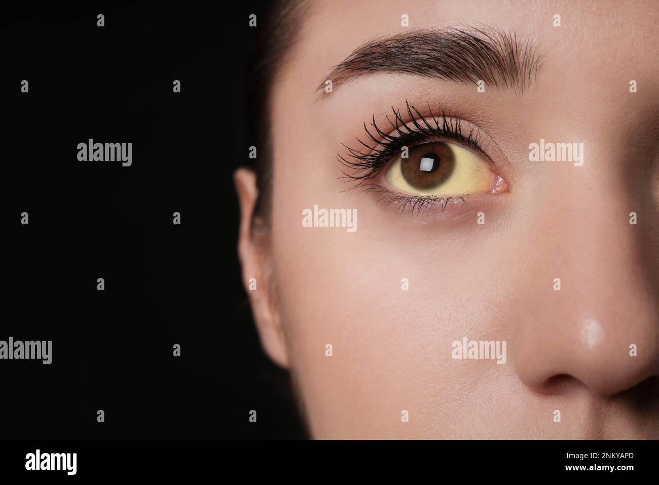 Femme avec des yeux jaunes sur fond noir, gros plan et espace pour le texte. Symptômes des problèmes hépatiques Banque D'Images