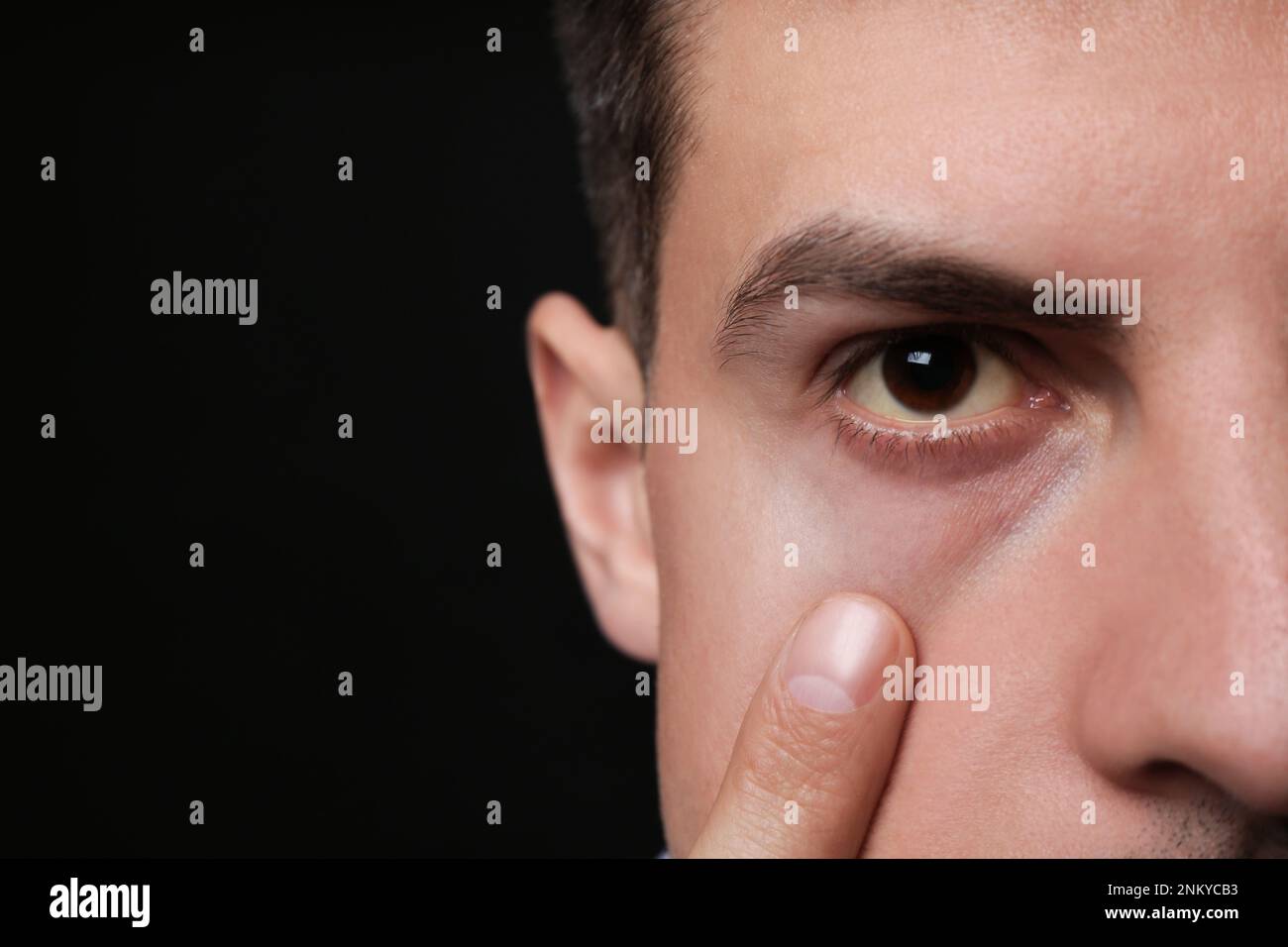 Homme vérifiant son état de santé sur fond noir, gros plan et espace pour le texte. Yeux jaunes comme symptôme de problèmes avec le foie Banque D'Images