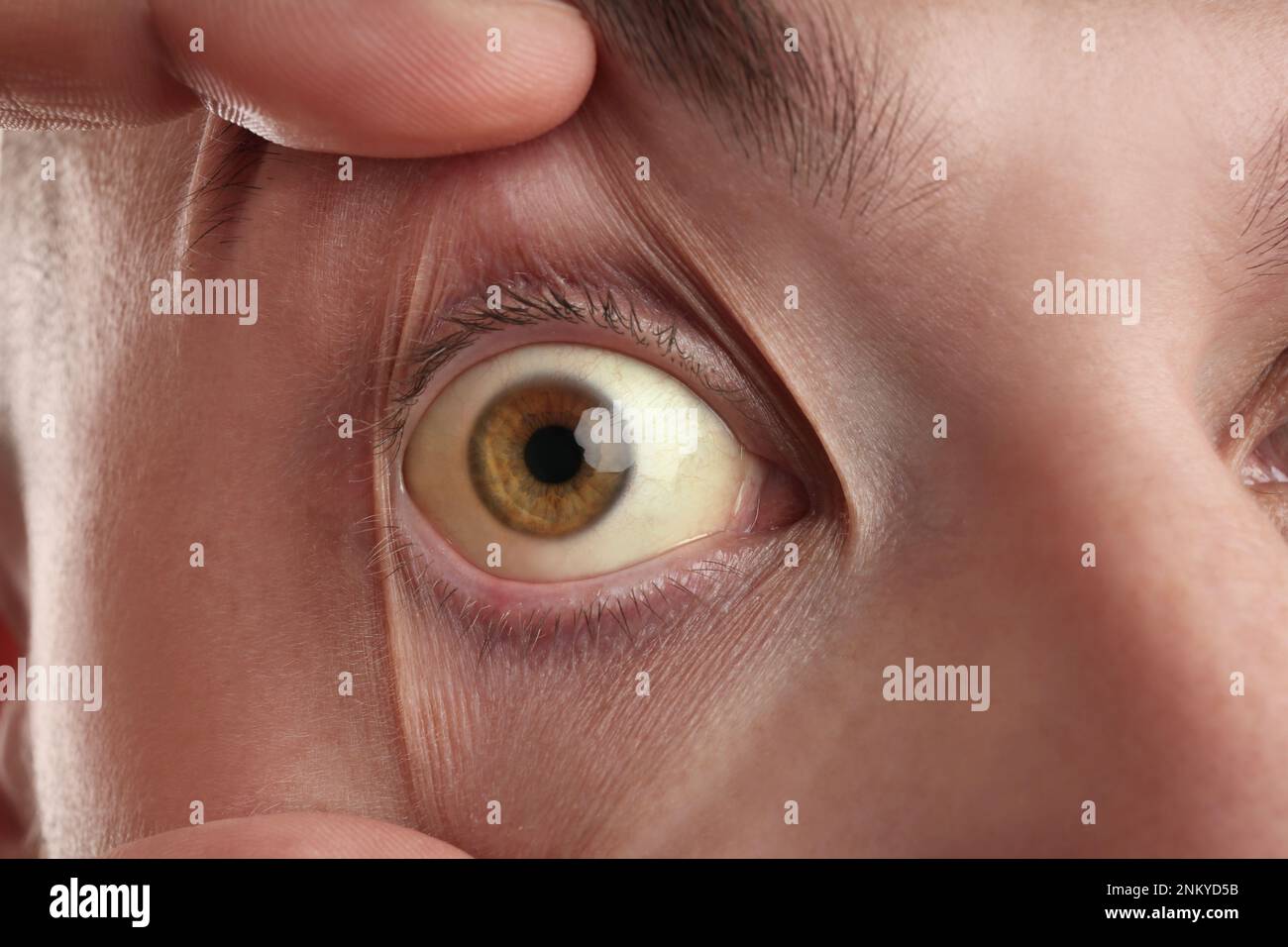 Homme vérifiant son état de santé, gros plan. Yeux jaunes comme symptôme de problèmes avec le foie Banque D'Images