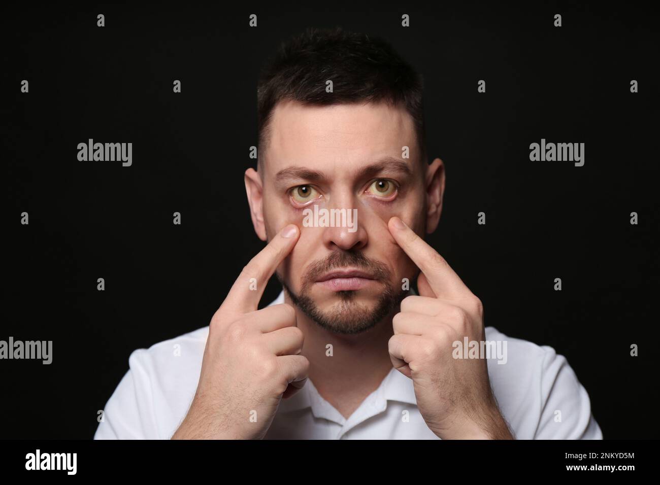 Homme vérifiant son état de santé sur fond noir. Yeux jaunes comme symptôme de problèmes avec le foie Banque D'Images