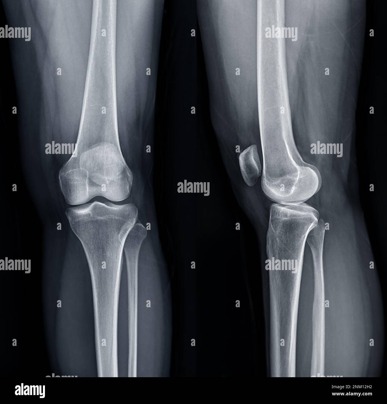 Film de rayons X de l'articulation du genou gauche AP et vue latérale pour le diagnostic de la douleur du genou de l'arthrose genou et de la fracture . Banque D'Images Film de rayons X de l'articulation du genou gauche AP et vue latérale pour le diagnostic de la douleur du genou de l'arthrose genou et de la fracture . Banque D'Images