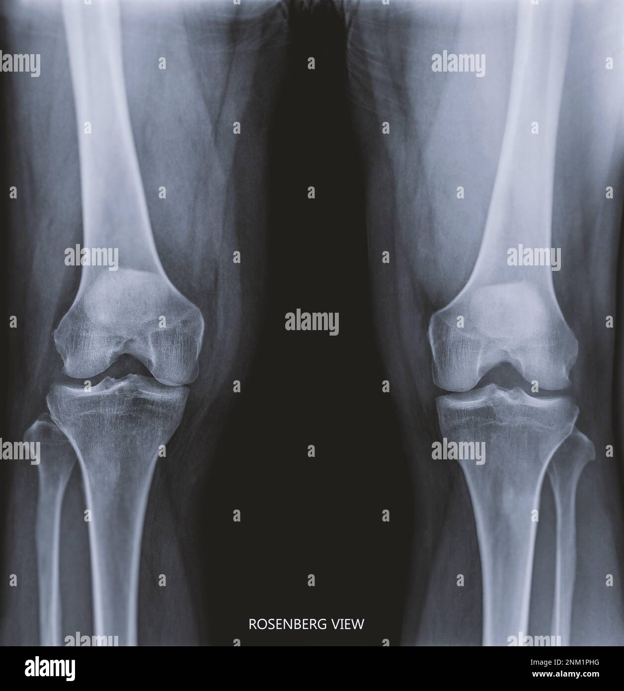 Film x-ray les deux articulation du genou AP nom de la vue est Rosenberg vue pour le diagnostic de la douleur du genou de l'arthrose genou et de la fracture . Banque D'Images Film x-ray les deux articulation du genou AP nom de la vue est Rosenberg vue pour le diagnostic de la douleur du genou de l'arthrose genou et de la fracture . Banque D'Images