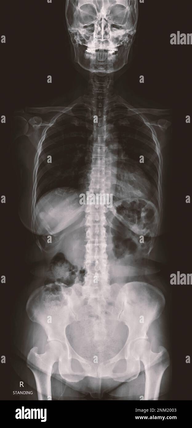 Image radiographique de la colonne vertébrale entière pour le diagnostic de scoliose de la colonne vertébrale. Banque D'Images