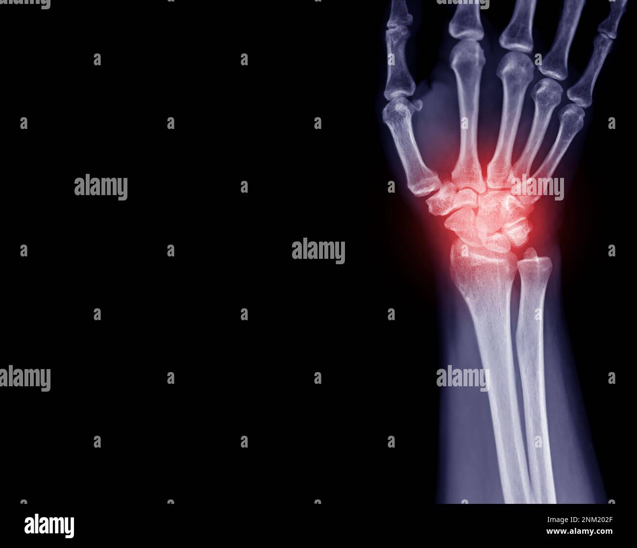 Image radiographique de l'articulation du poignet vue avant de l'articulation du poignet normale. Banque D'Images