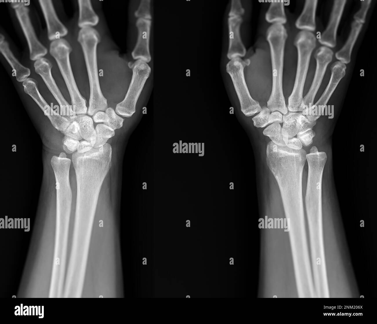 Image radiographique de l'articulation du poignet vue avant de l'articulation du poignet normale. Banque D'Images