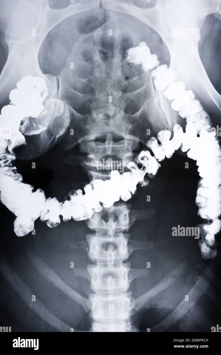 Radiographie à rayons X de la région pelvienne d'un humain. Visualisation de l'intestin. Banque D'Images