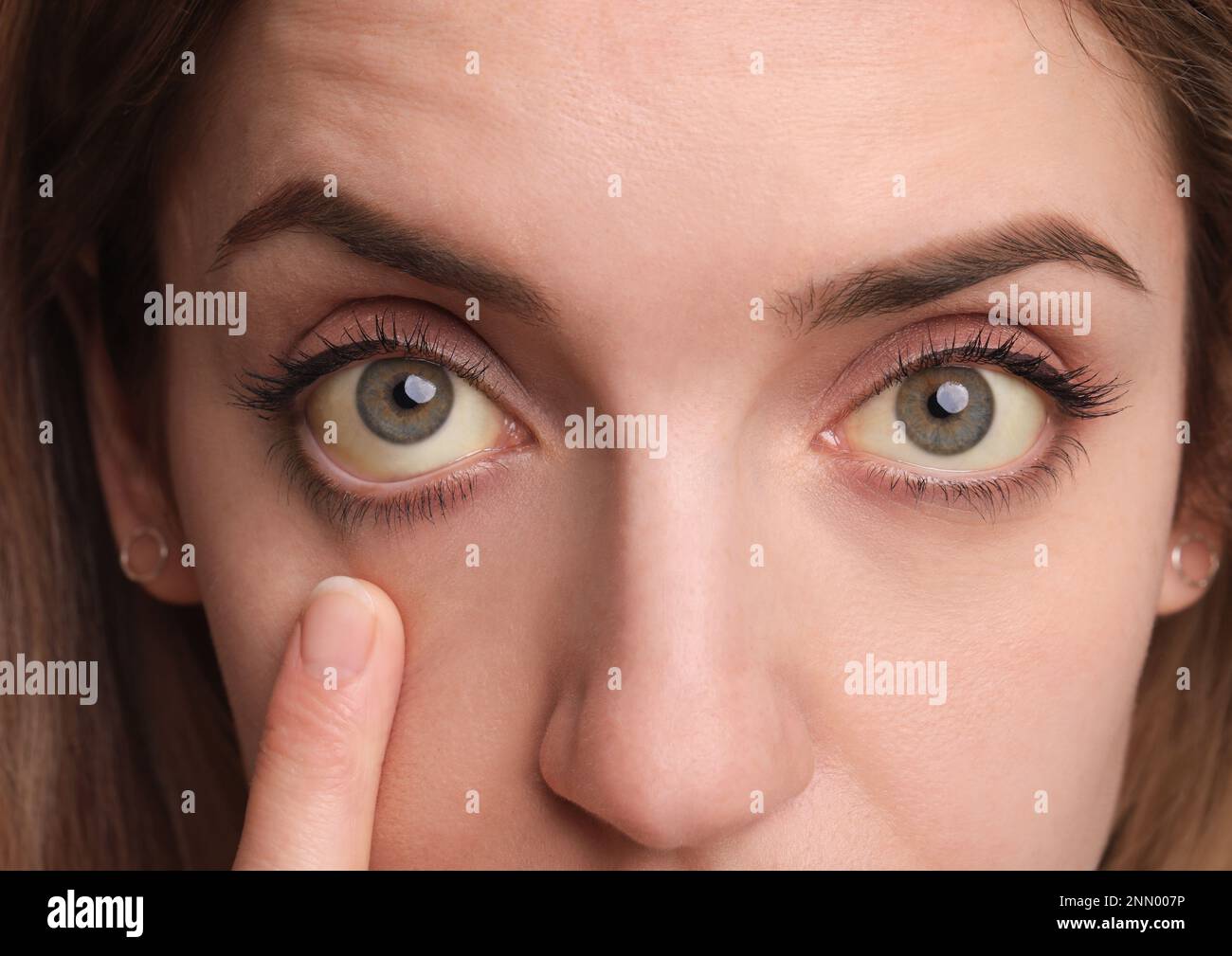 Femme vérifiant son état de santé sur fond blanc, gros plan. Yeux jaunes comme symptôme de problèmes avec le foie Banque D'Images
