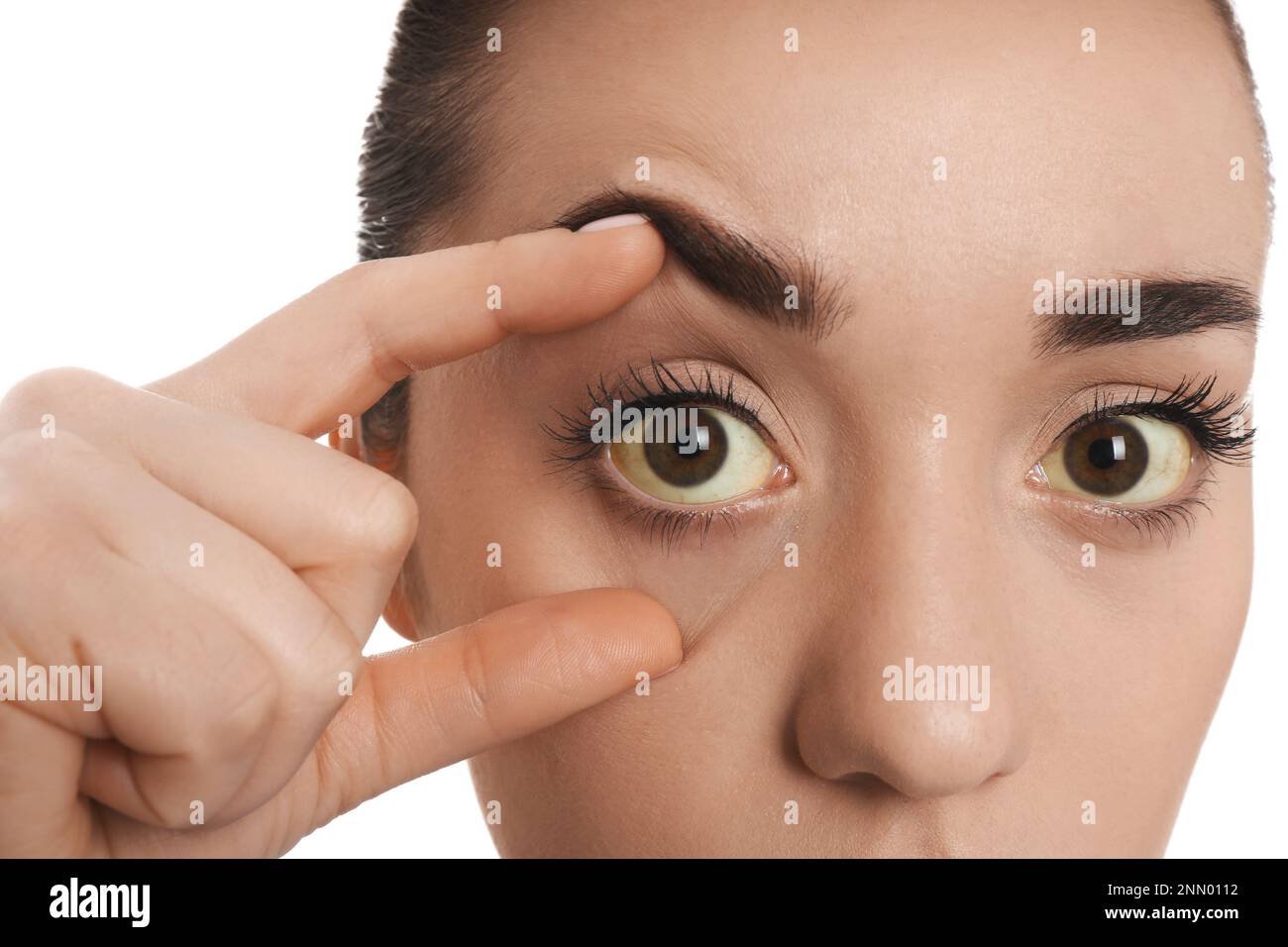 Femme vérifiant son état de santé sur fond blanc, gros plan. Yeux jaunes comme symptôme de problèmes avec le foie Banque D'Images
