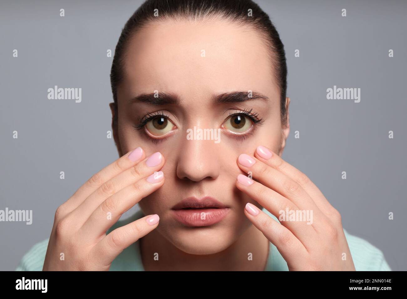 Femme vérifiant son état de santé sur fond gris. Yeux jaunes comme symptôme de problèmes avec le foie Banque D'Images