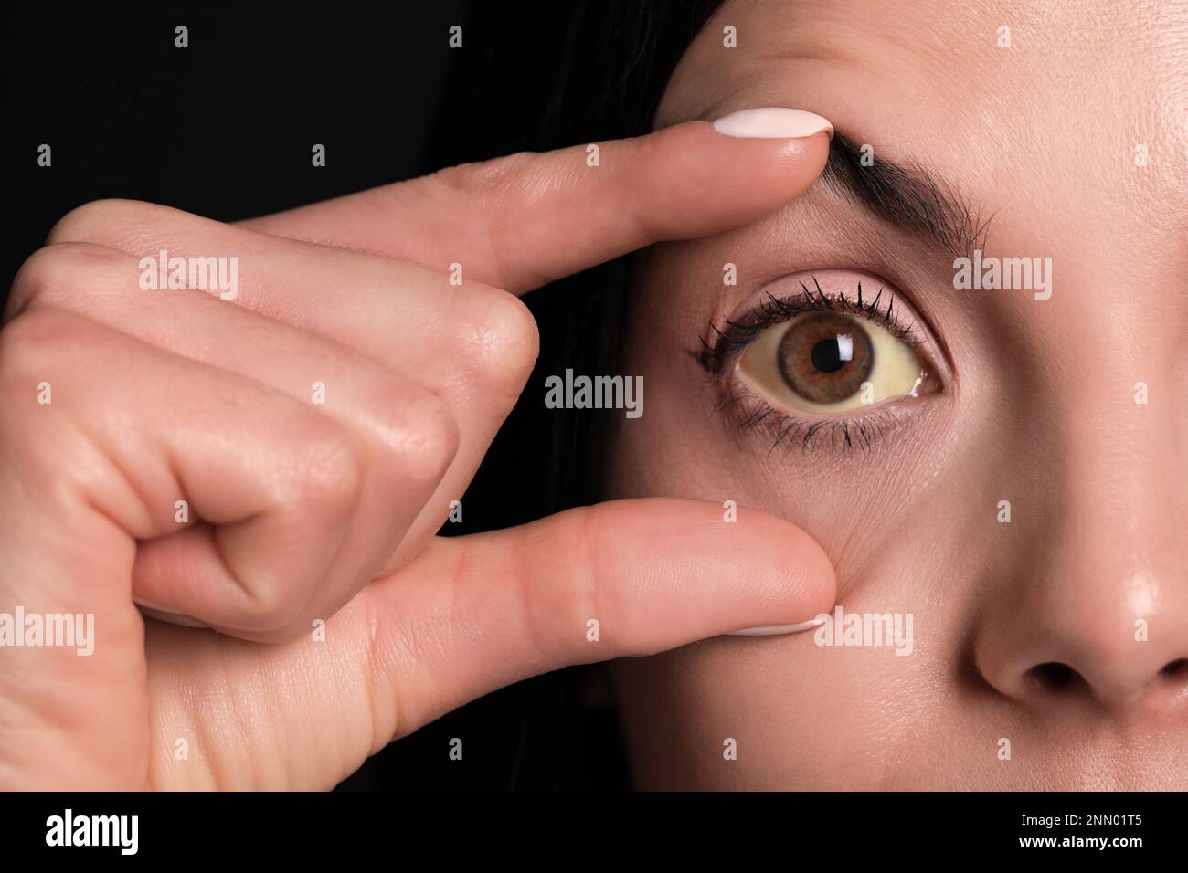 Femme vérifiant son état de santé sur fond noir, gros plan. Yeux jaunes comme symptôme de problèmes avec le foie Banque D'Images
