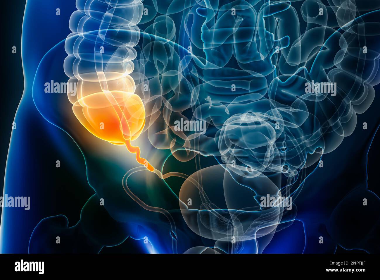 Appendicite maladie ou vermiform annexe inflammation 3D illustration de rendu. Anatomie, chirurgie, biomédical, maladie, médical, biologie, science, h Banque D'Images